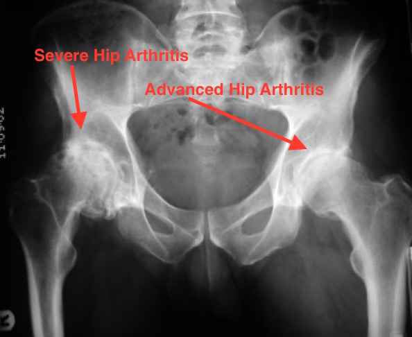 https://www.kneeandhip.co.uk/wp-content/uploads/2016/08/1.-Hip-Arthritis-on-X-ray-1.jpg