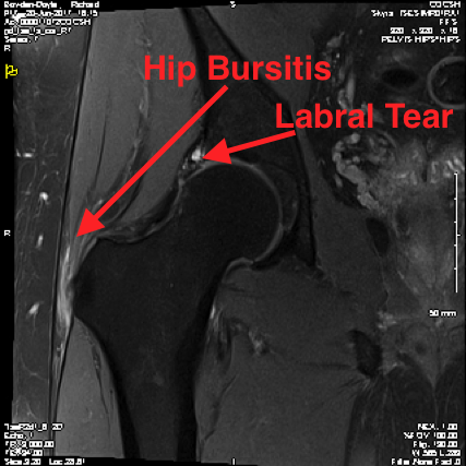 bursa hip mri