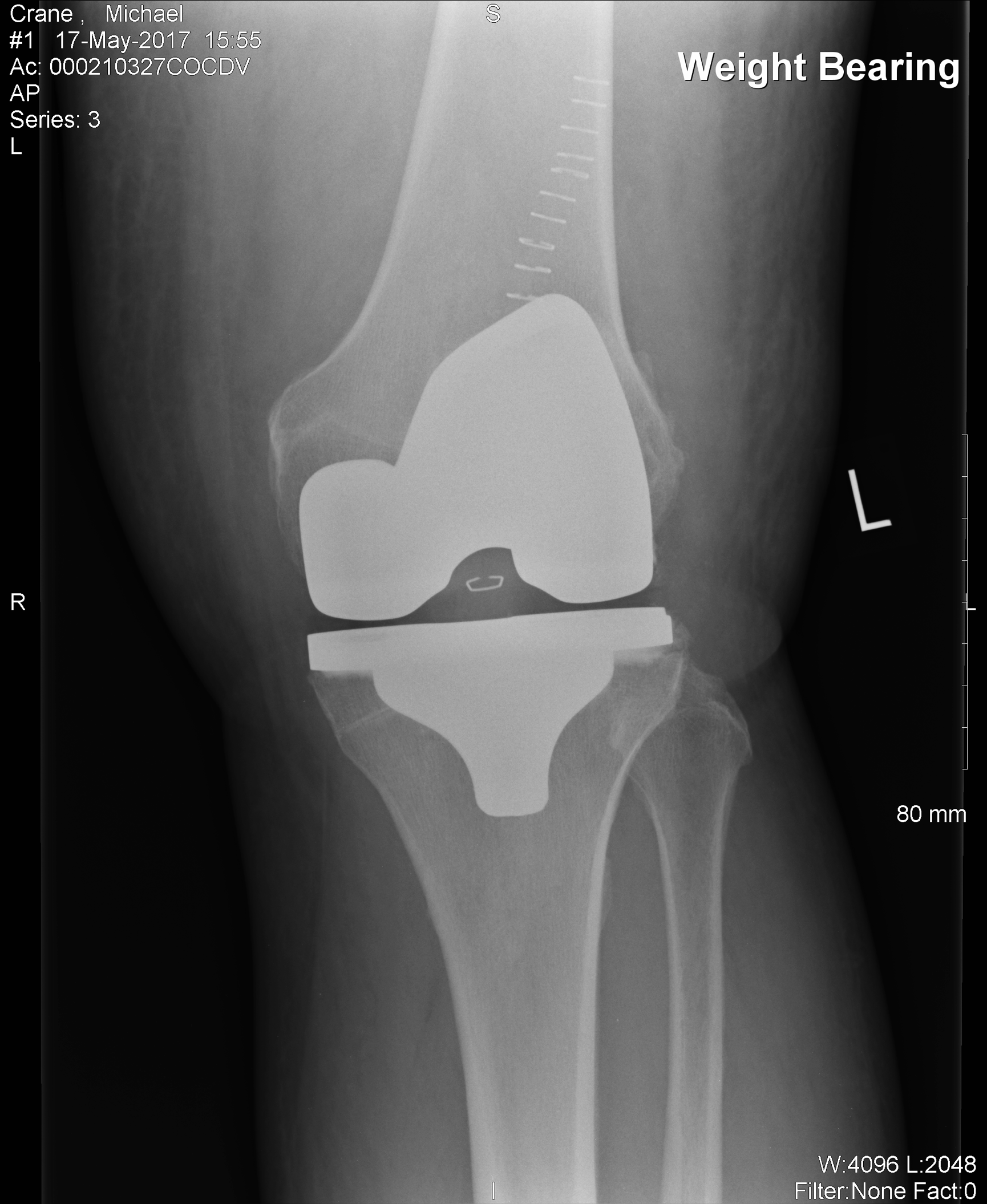 https://www.kneeandhip.co.uk/wp-content/uploads/2016/08/3.-X-ray-of-Knee-Replacement.png