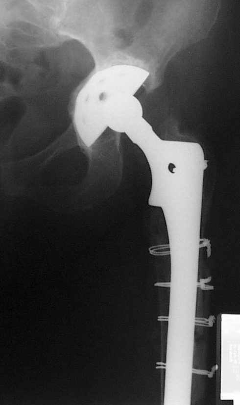 https://www.kneeandhip.co.uk/wp-content/uploads/2016/08/3.-X-ray-of-a-Revision-Hip-Replacement.jpg