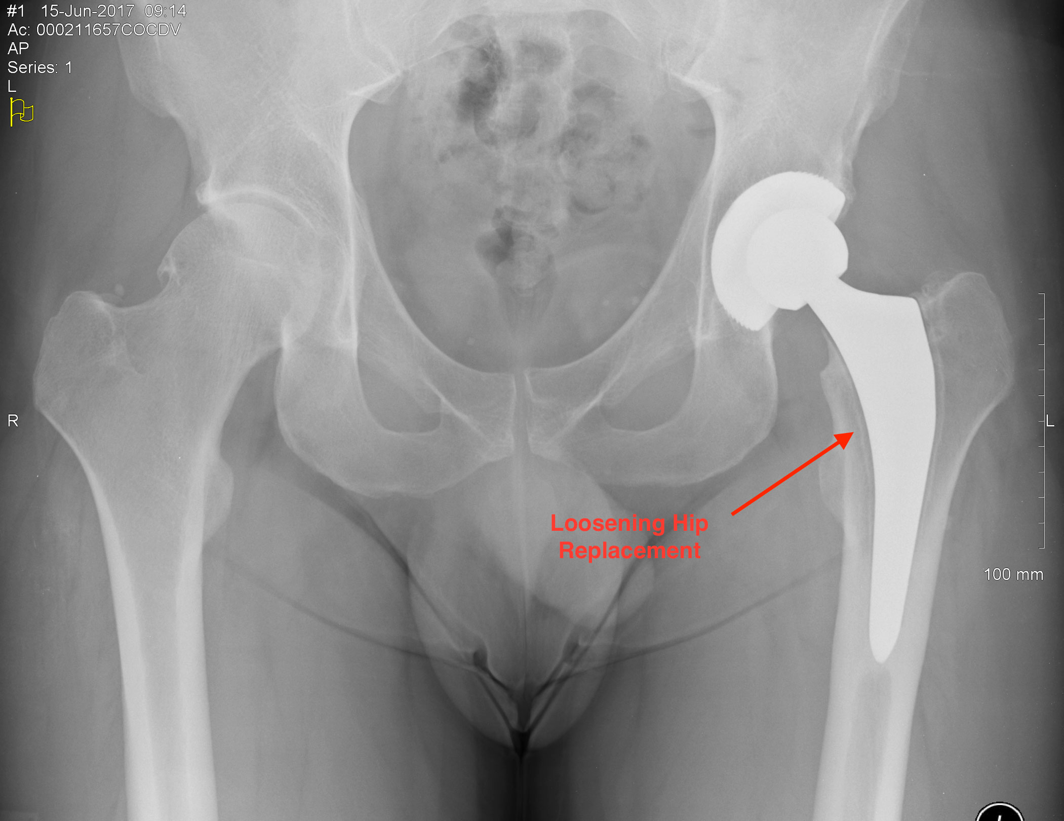 https://www.kneeandhip.co.uk/wp-content/uploads/2016/08/Complications-of-Hip-Surgery.jpg