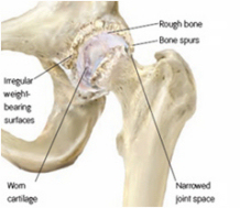 diagram-arthritic-hip