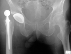 hip-dislocation-1