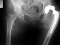 hip-dislocation