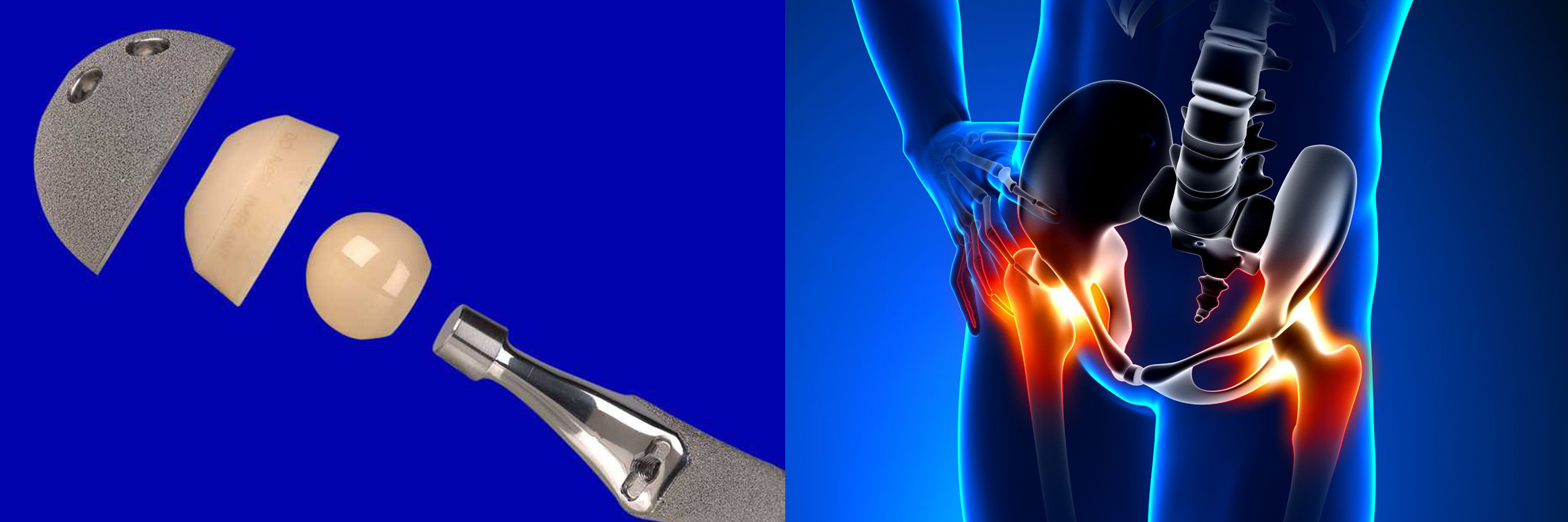 Abduction Wedge Hip Replacement thumbnail