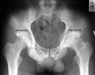 hip-x-ray-normal-hip-arthritis-hip