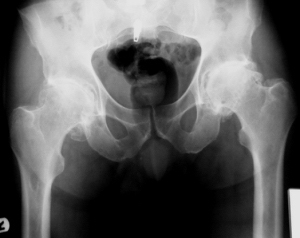 https://www.kneeandhip.co.uk/wp-content/uploads/2016/08/pair-of-arthritic-hips-hip-arthristis-photo-1-new.jpg