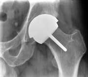 resurfacing-hip-replacement-3