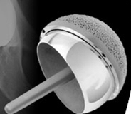 resurfacing-hip-replacement