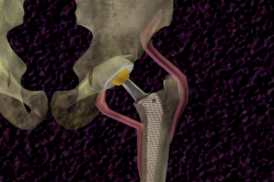 schematic-hip-replacement