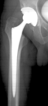 types-of-hip-replacement-2