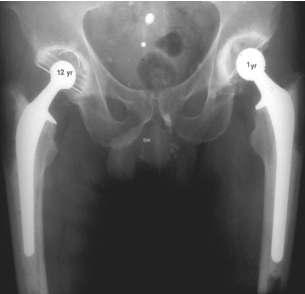 types-of-hip-replacement