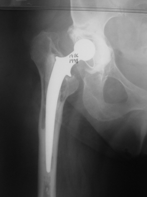 x-ray-loose-failing-hip