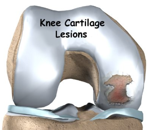 https://www.kneeandhip.co.uk/wp-content/uploads/2017/02/1.Knee-Cartilage-Injury-1.png