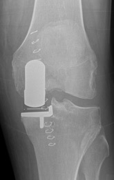 https://www.kneeandhip.co.uk/wp-content/uploads/2017/02/3.-X-ray-of-Uni-Knee-Replacement.jpg