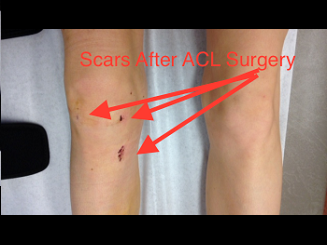 Anterior Cruciate Ligament Surgery Knee And Hip Website