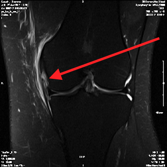 https://www.kneeandhip.co.uk/wp-content/uploads/2017/07/3.-MCL-Injury-on-MRI.png