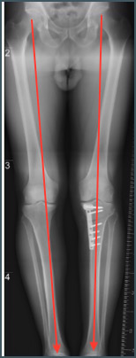 https://www.kneeandhip.co.uk/wp-content/uploads/2017/07/4.-Post-Op-X-ray-of-Osteotomy-Operation.jpg