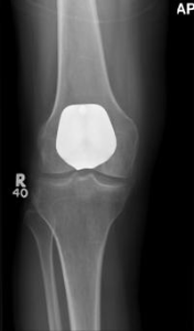 https://www.kneeandhip.co.uk/wp-content/uploads/2017/07/X-ray-of-PatelloFemoral-Replacement.png
